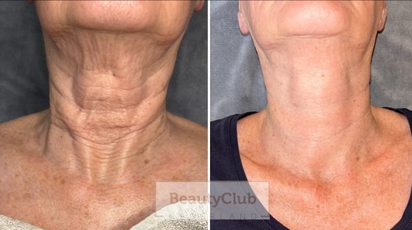 Neck lift voor/na